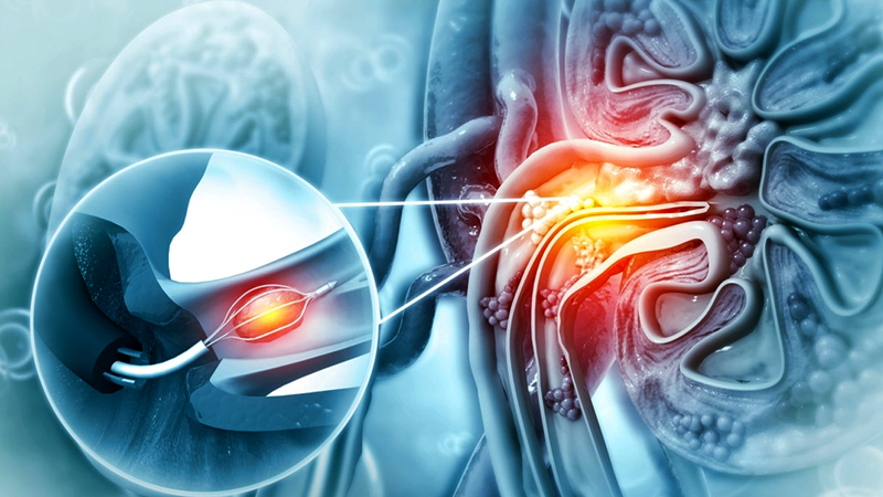 Foreign Body Removal - Velura Clinic